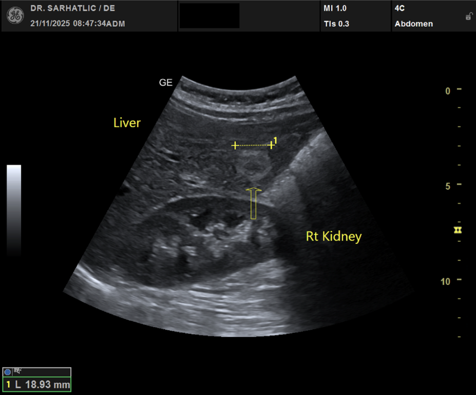 Ultraschallbild der Leber mit gutartigem Tumor und Niere