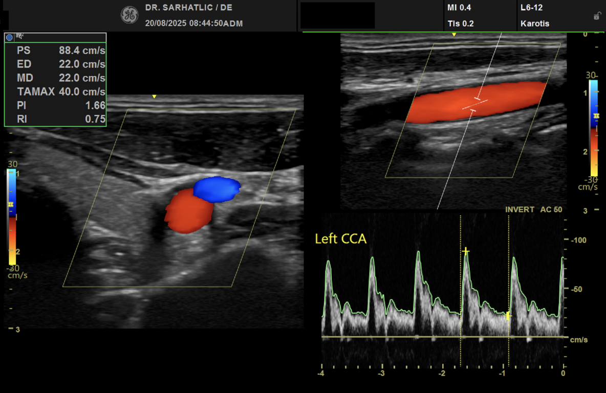 Gefäßultraschall mit Farbdoppler der Halsarterie