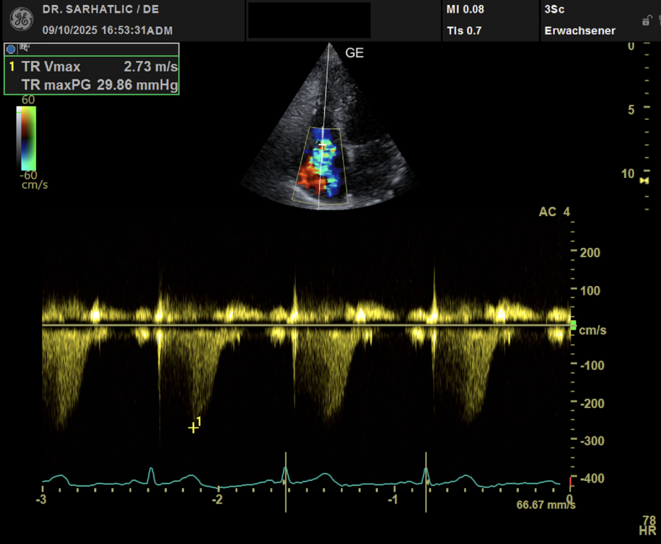 Herzultraschall bei Trikuspidalinsuffizienz