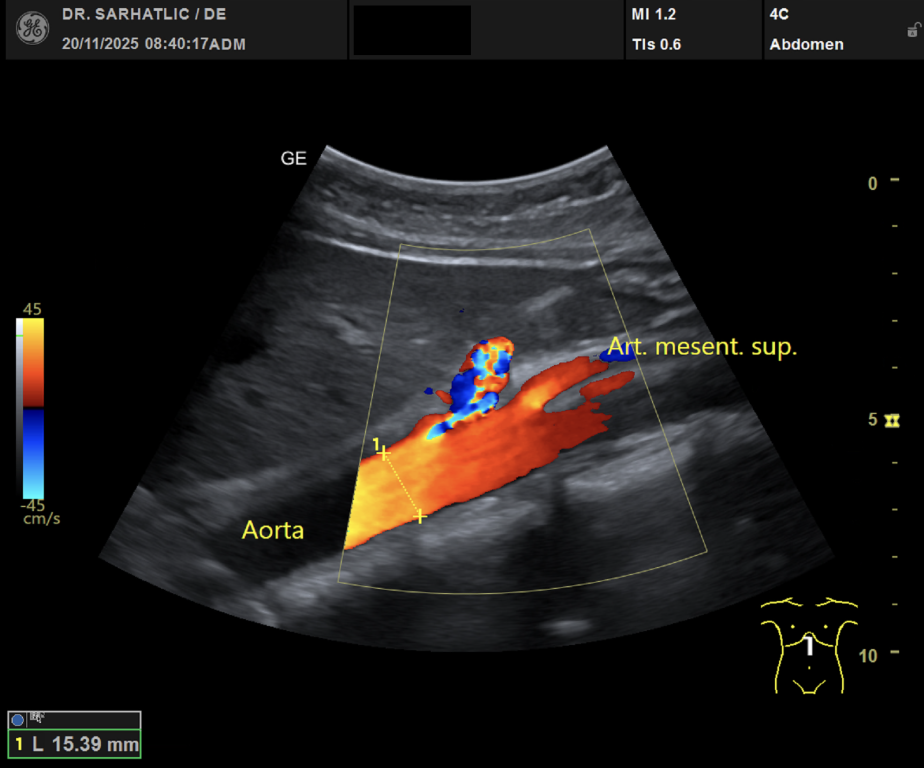 Ultraschallbild Farbduplex der Aorta