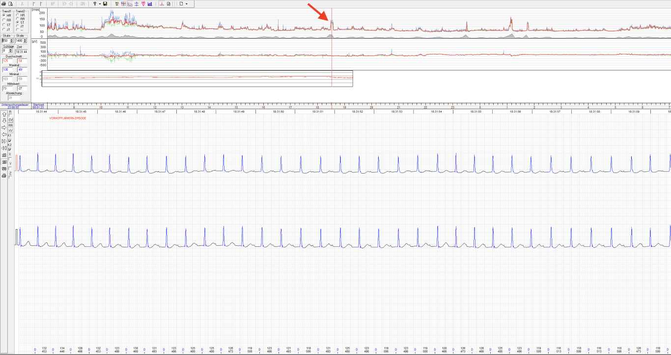 Analysesoftware Langzeit-EKG mit Erstdiagnose Vorhofflimmern