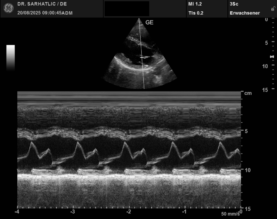Herzultraschall Darstellung der vorderen Mitralsegel