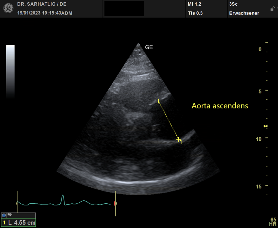 Herzultraschall Erstdiagnose Aortenaneurysma