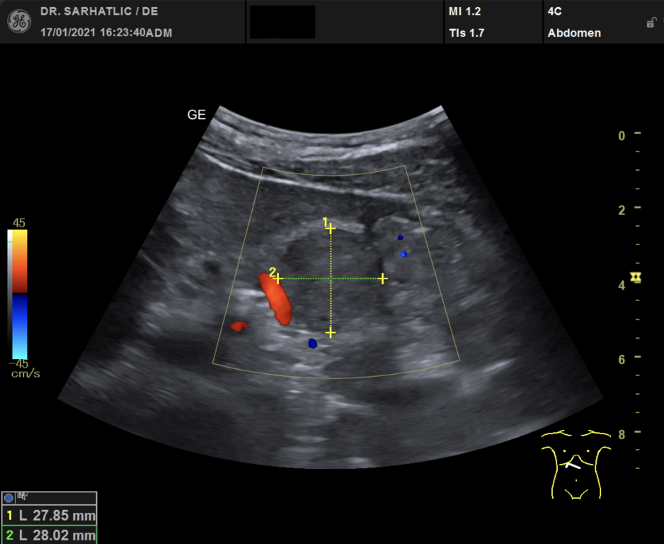 Ultraschallbild Pankreastumor