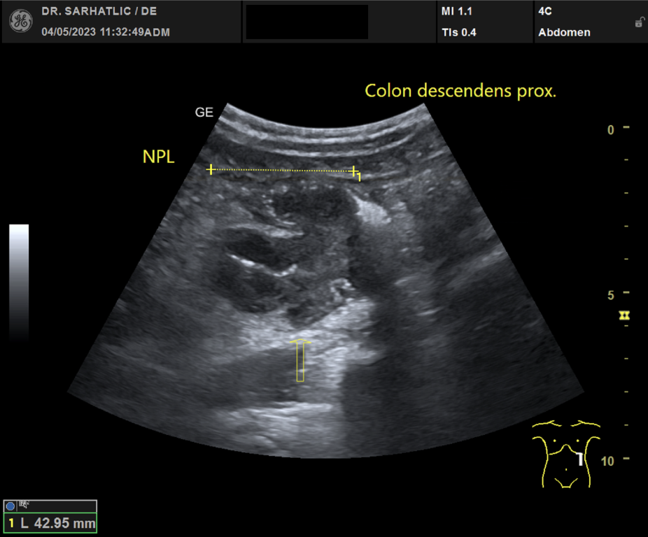 Ultraschallbild Darmtumor